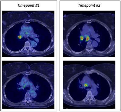 Case report: Successful use of mepolizumab for immune checkpoint inhibitors–induced hypereosinophilic syndrome in two patients with solid malignancies